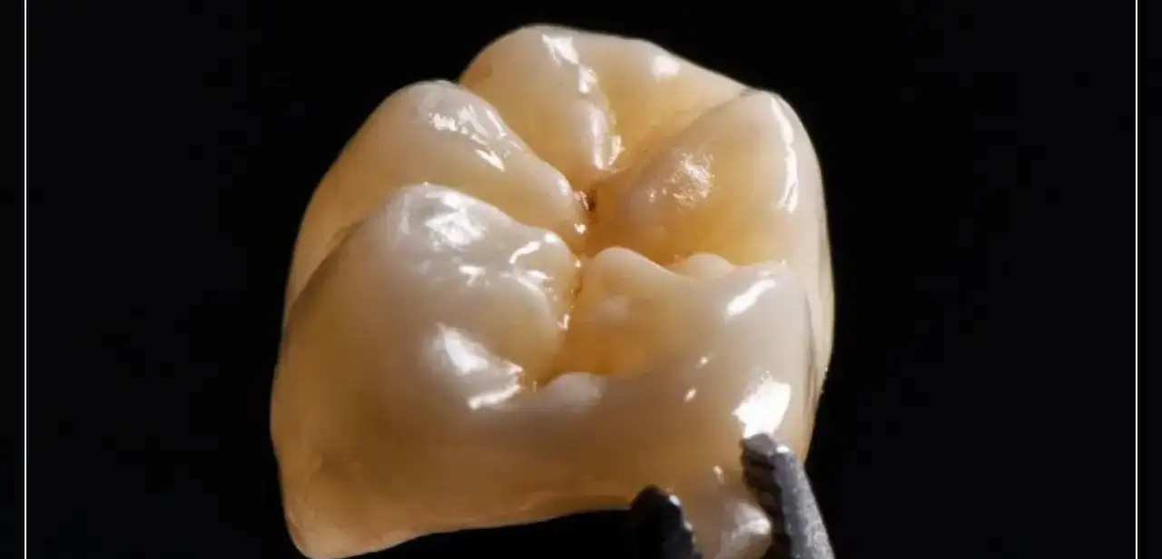 Vue détaillée d'une couronne dentaire en céramique sur fond noir, mettant en avant sa finition réaliste et esthétique.