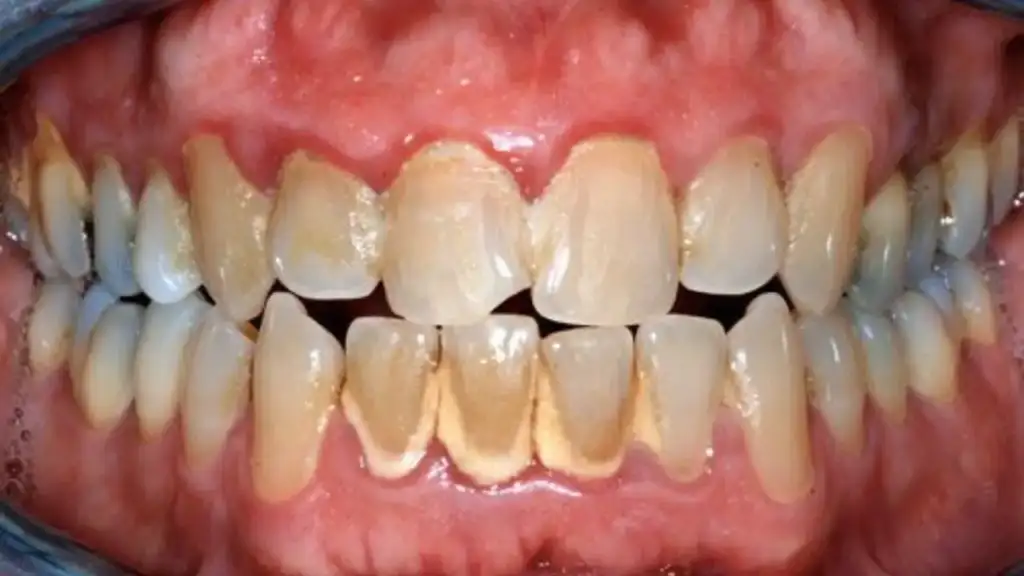 Une image de dents recouvertes de plaque et de tartre, illustrant une cause fréquente de mauvaise haleine et de problèmes bucco-dentaires.