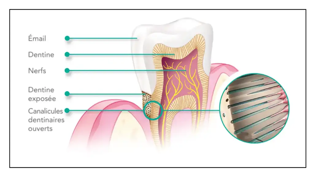 Schéma d'une dent montrant la dentine exposée, les canalicules ouverts et les nerfs responsables de la sensibilité dentaire