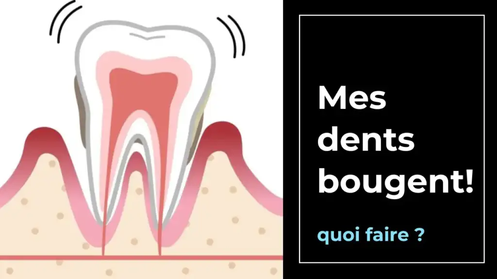 Illustration d'une dent mobile avec le texte "Mes dents bougent! Quoi faire ?", mettant en avant les solutions pour stabiliser les dents et prévenir les problèmes dentaires. Par Le Bord Libre.